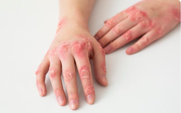 South Carolina Measles Outbreak South Carolina Measles Outbreak