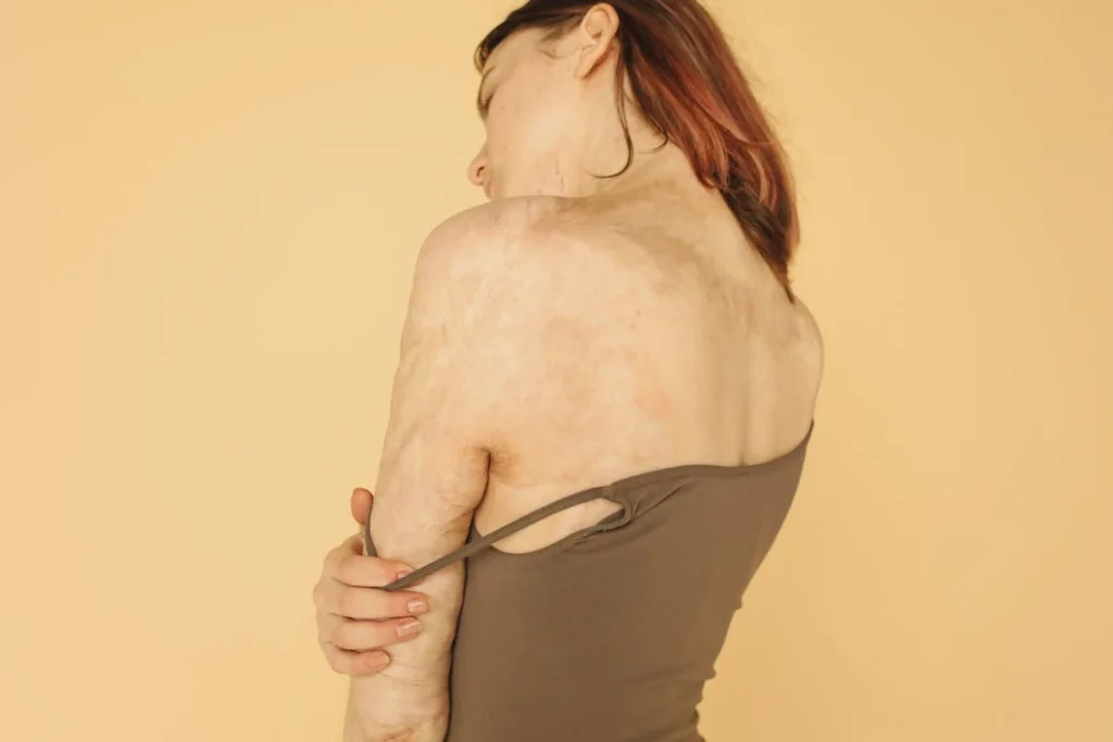 scar recovery